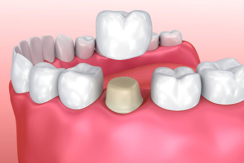 Affinity Dental Crown