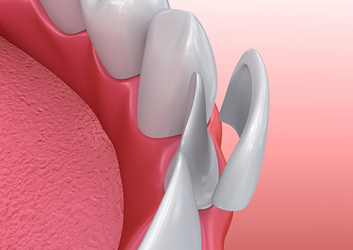 affinity dental veneers