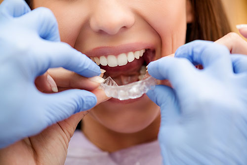 Invisalign treatment affinity dental